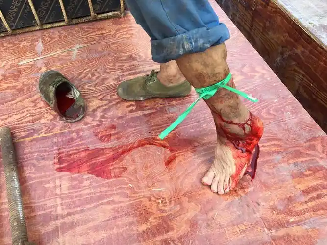 工人被钢筋划破.