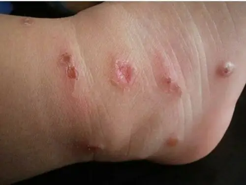虫咬性皮炎敏症状图片_有来医生