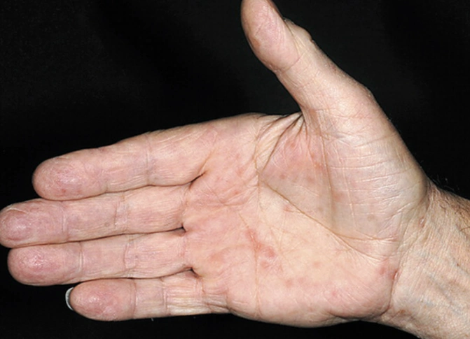 梅毒前期小红点图片 (13)