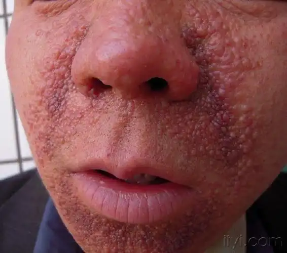 面部多发丘疹10余年 - 皮肤及性传播疾病讨论版 - 爱爱医医学论坛