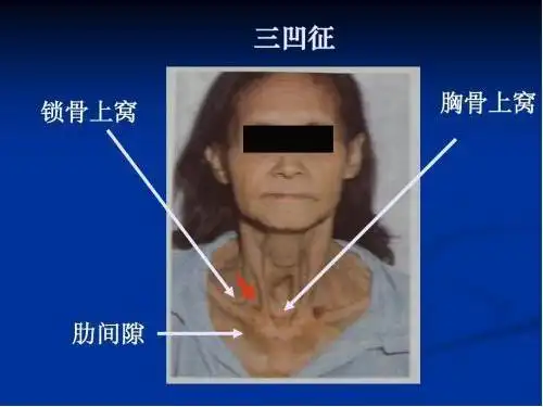 附件 三凹征.jpg