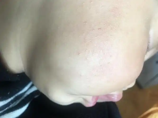 宝宝脸上米粒似的小点是怎么回事?