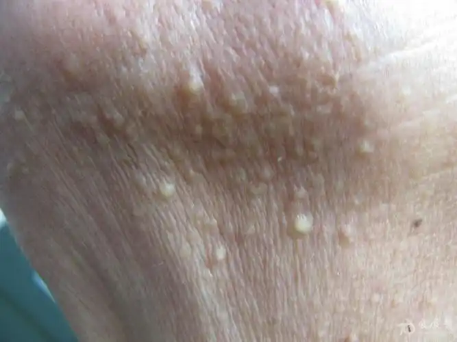 颈部结节粟丘疹