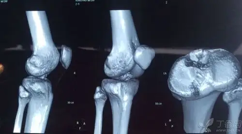 胫骨髁间棘骨折