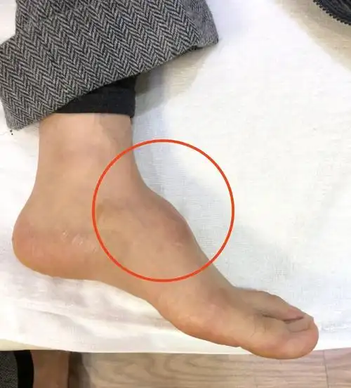 黄晓明晒脚背照否认垫增高鞋垫曾和范冰冰一起上节目就谈过此事