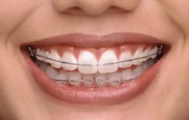 矫正的是牙齿,改变的是人生!