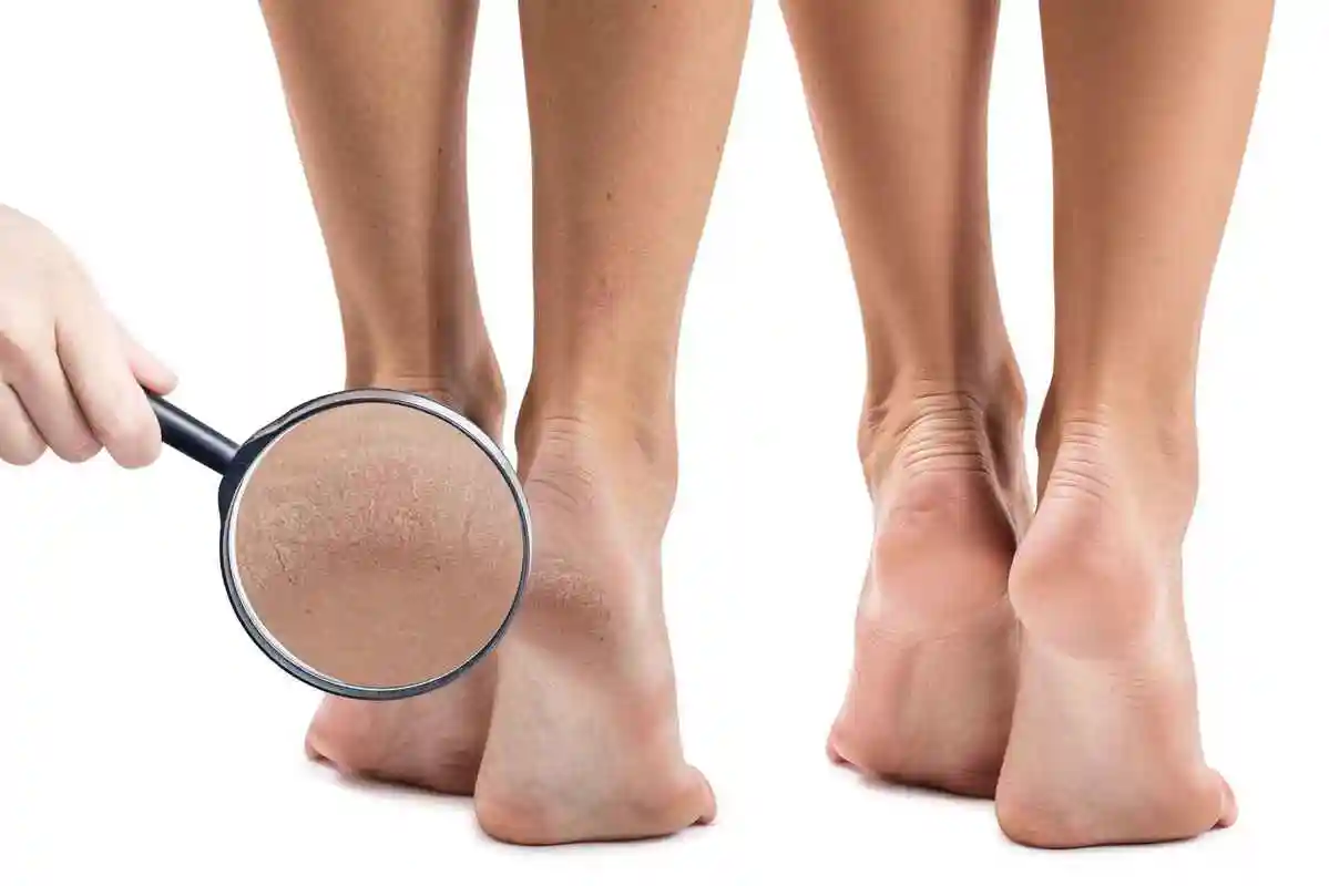 脚后跟开裂,别只怪缺水,医生:做好3步或有效改善