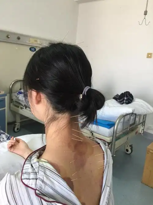 1月24日—2月6日 琪琪住院系统治疗颈椎病 加油