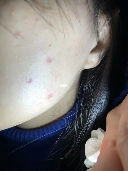 1月21号,点完痣的第21天,用灯光打着的时候能看见上面两个点的比较深