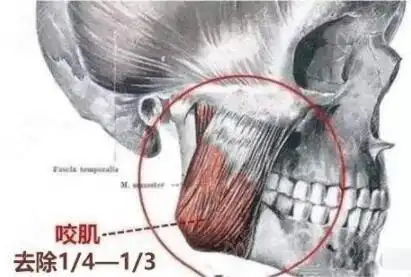 下颌角手术同时去咬肌好吗是不是去除全部咬肌瘦脸更明显
