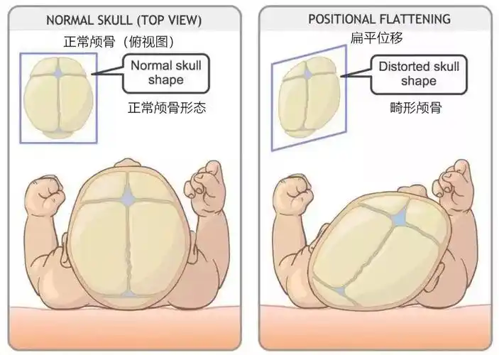 新生儿的头颅非常柔软,这有利于顺利通过产道,但如果长期睡觉时头都是