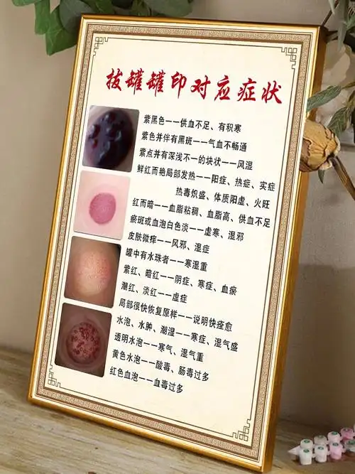 颈肩腰腿痛海报罐印颜色分析拔罐刮痧艾灸针灸写真
