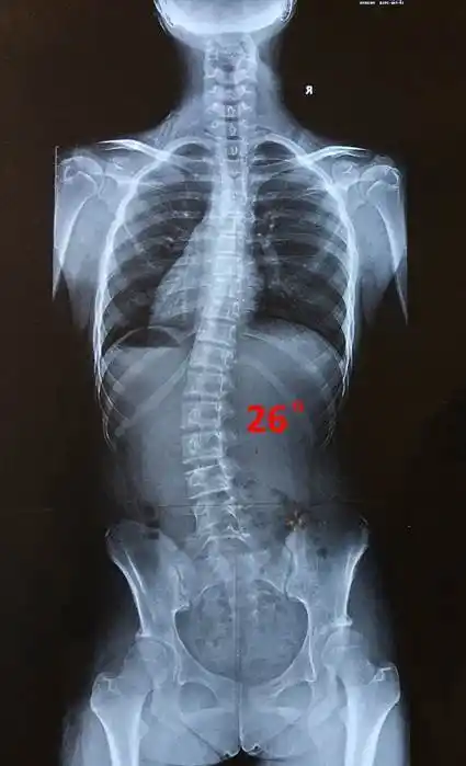 庄乾宇医生讲脊柱侧凸系列之三孩子得了脊柱侧凸该怎么办要手术吗什么