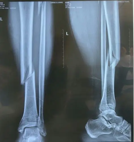 胫腓骨骨折闭合复位髓内钉固定两例