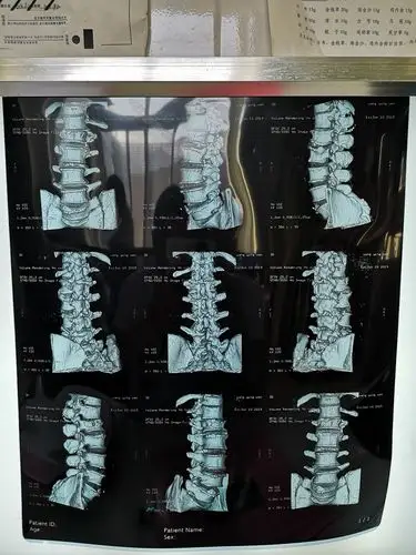 术前c t见腰椎爆裂性骨折