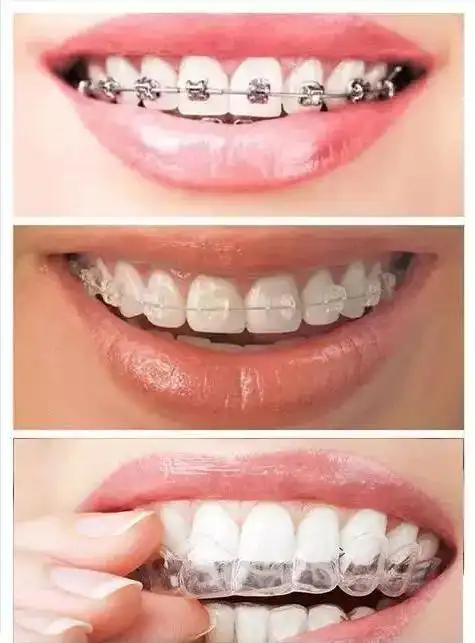 牙齿矫正,为什么有的人花几千,有的人花几万?