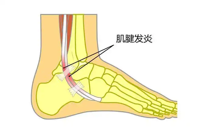小腿内侧外侧前方出现疼痛最常见的原因是什么