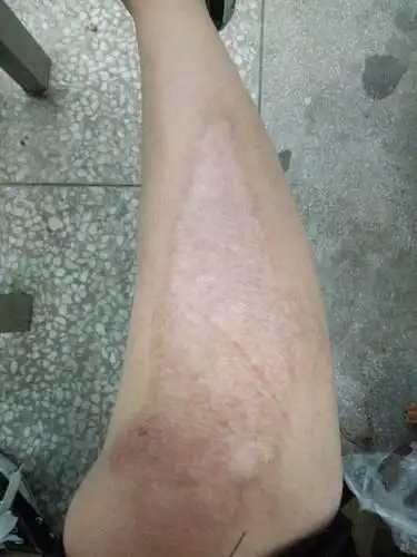 去年这个时候骑车翻车摔伤,腿长一大块的疤 但是没有凹凸不平,只是