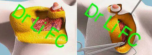 乳房缩小术(三):垂直切口乳房缩小术(vertical breast reduction)