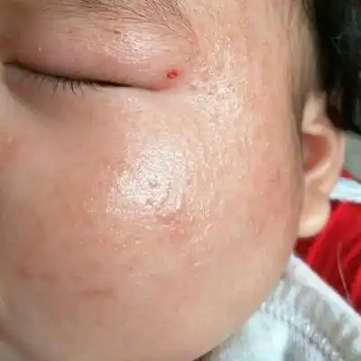 宝宝三个多月脸上湿疹反覆不好,去医院医生说是痤疮,回来用药一开始有