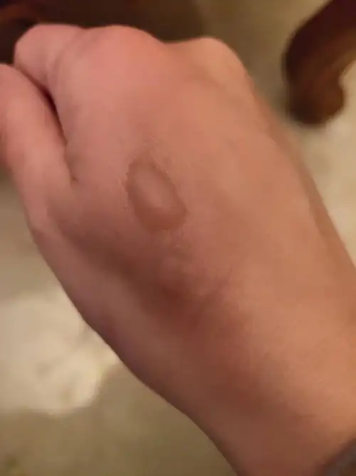 问:医生好,我的手被开水烫伤起了水泡,想知道如何处理能尽量不落下