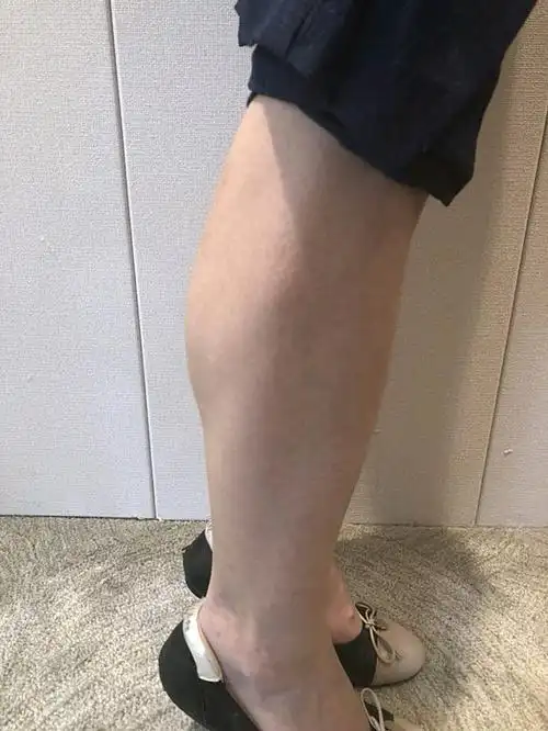 我本身就是肌肉型小腿,折腾了很久都瘦不下去才考虑去_圈子-新氧美容