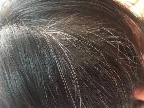 十几二十岁的学生满头白发究竟是怎么回事