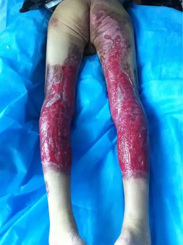 某某,男,76岁,双下肢三度烧伤,既往高血压脑出血后遗症,慢支病史,生活