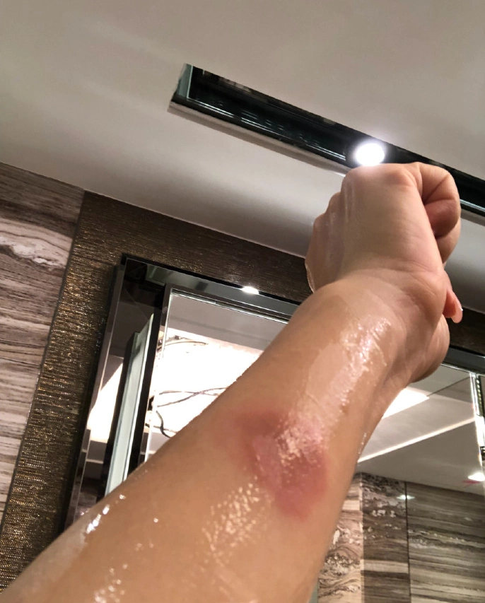 51岁陈法蓉为爸爸做饭烫伤手臂,发文晒照求助!网友:不要再湿水