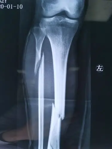 经皮微创接骨板固定技术(mippo)治疗双胫骨粉碎性骨折