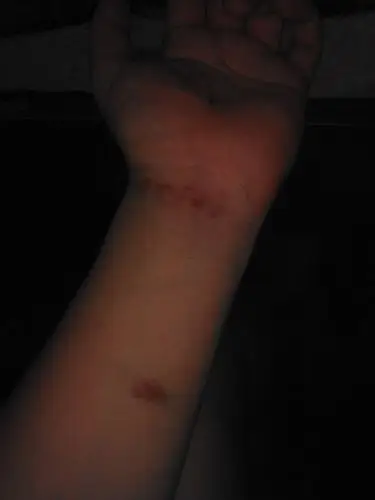 我手腕上有一条长长的疤痕会不会对我的未来发展有限制对未来我的仕