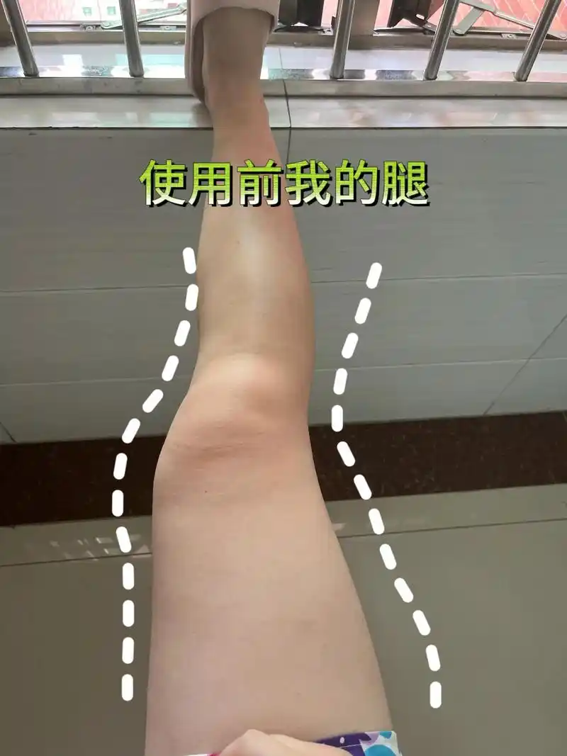 姐妹们,腿型不好的,走路姿势不正确的,可以试试.#小腿外翻# - 抖音