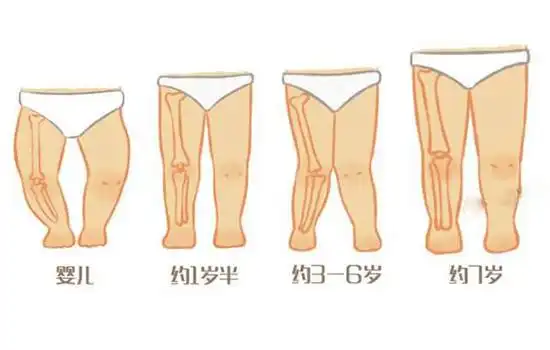 怎样判断宝宝是不是o型腿
