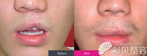 唇腭裂修复多少钱广州上海北京唇腭裂整形医院排名及价格