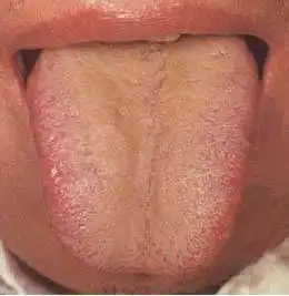 61张高清舌诊图谱,图文对照(珍藏版)_舌苔