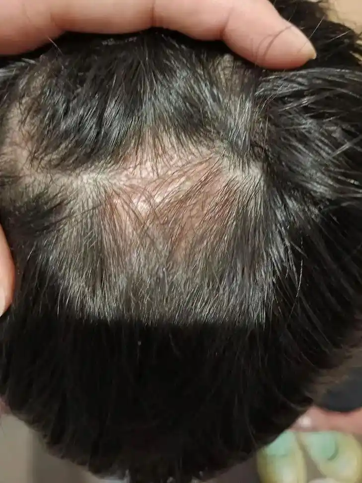 综上所述,儿童头癣是一种由真菌感染引起的皮肤病,具有传染性