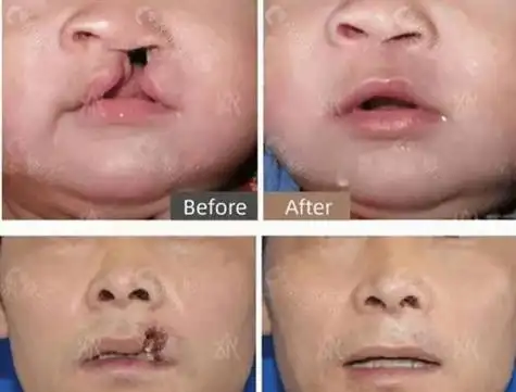 这家医院具备四级整形手术资质,其中轮廓手术和失败修复手术是他们家