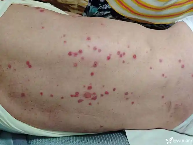 求助|脑梗卧床老年病人后背大面积皮肤红疹