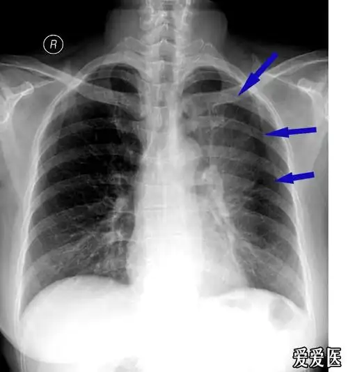 发张典型的左肺上叶不张的图片大家看下哈