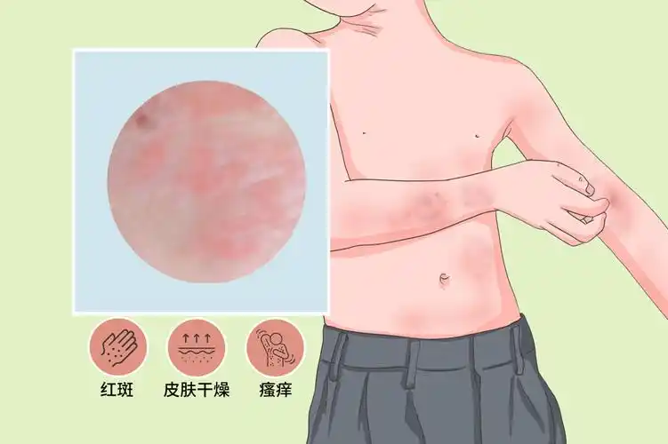 概述  就诊科室:   皮肤科 是否医保: 是 英文名称:   atopic