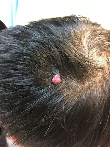 皮肤肿瘤血管瘤