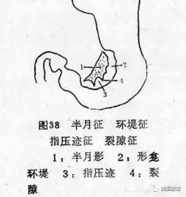x线诊断要点丨胃肿瘤的那些概念和征象