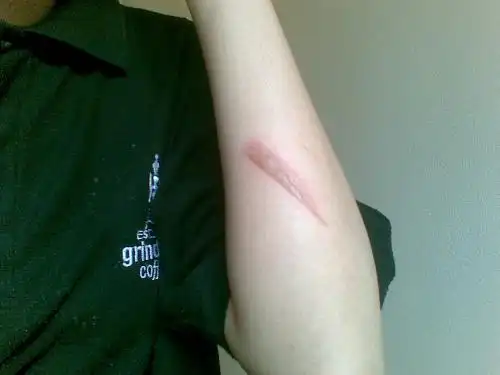 烫伤起水泡该怎么处理?