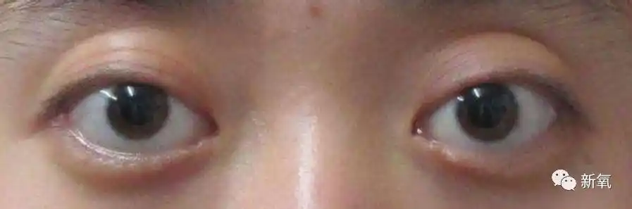 赵丽颖再戴眼镜可能就要变成脸颊凹陷颧骨突出了