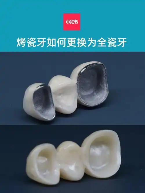 全瓷牙与烤瓷牙哪个好 ?