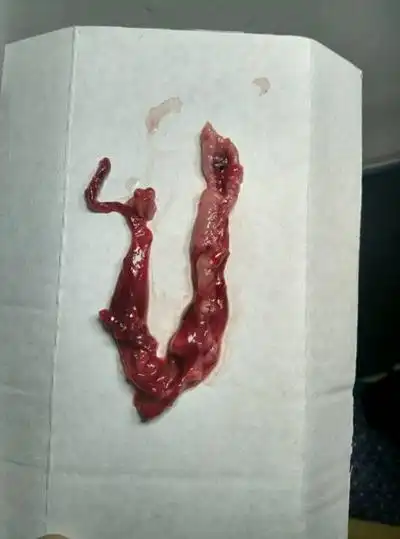 流产掉下来的孕囊图片 (50)