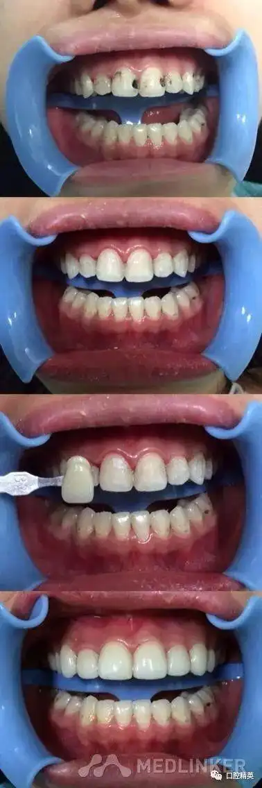 门牙超薄贴面美容修复