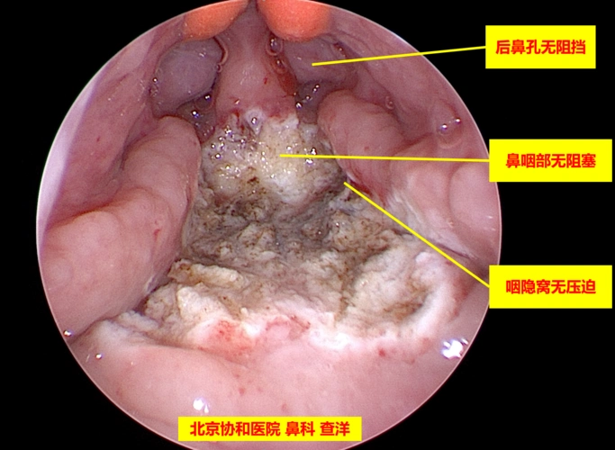 腺样体肥大的危害以及是否必需要手术?_小儿腺样体肥大_介绍_治疗方式