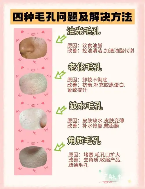 4种毛孔粗大类型,你是哪一种?