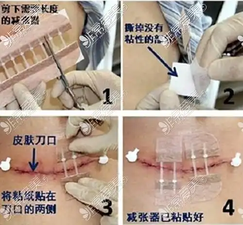 胸部太大且下垂想做乳房缩小术请问武汉缩胸手术哪里好